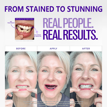 Clinclii™  Whitening Strips – Professional Teeth Whitening at Home